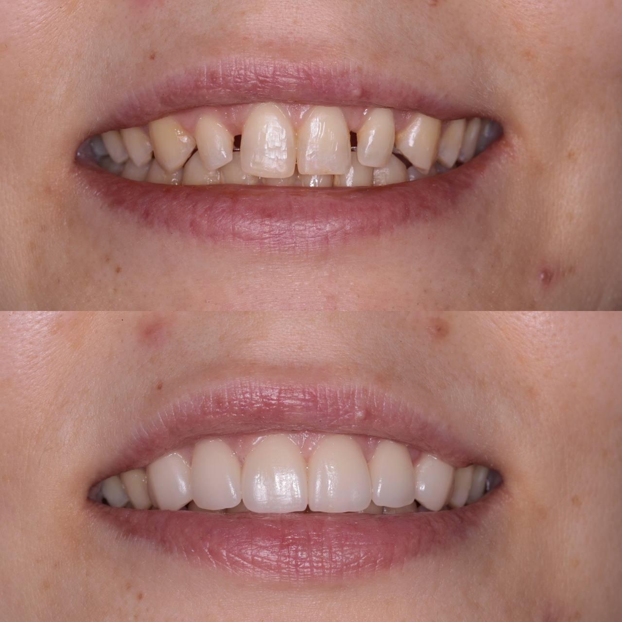 Emax Press ceramic veneers on individual teeth