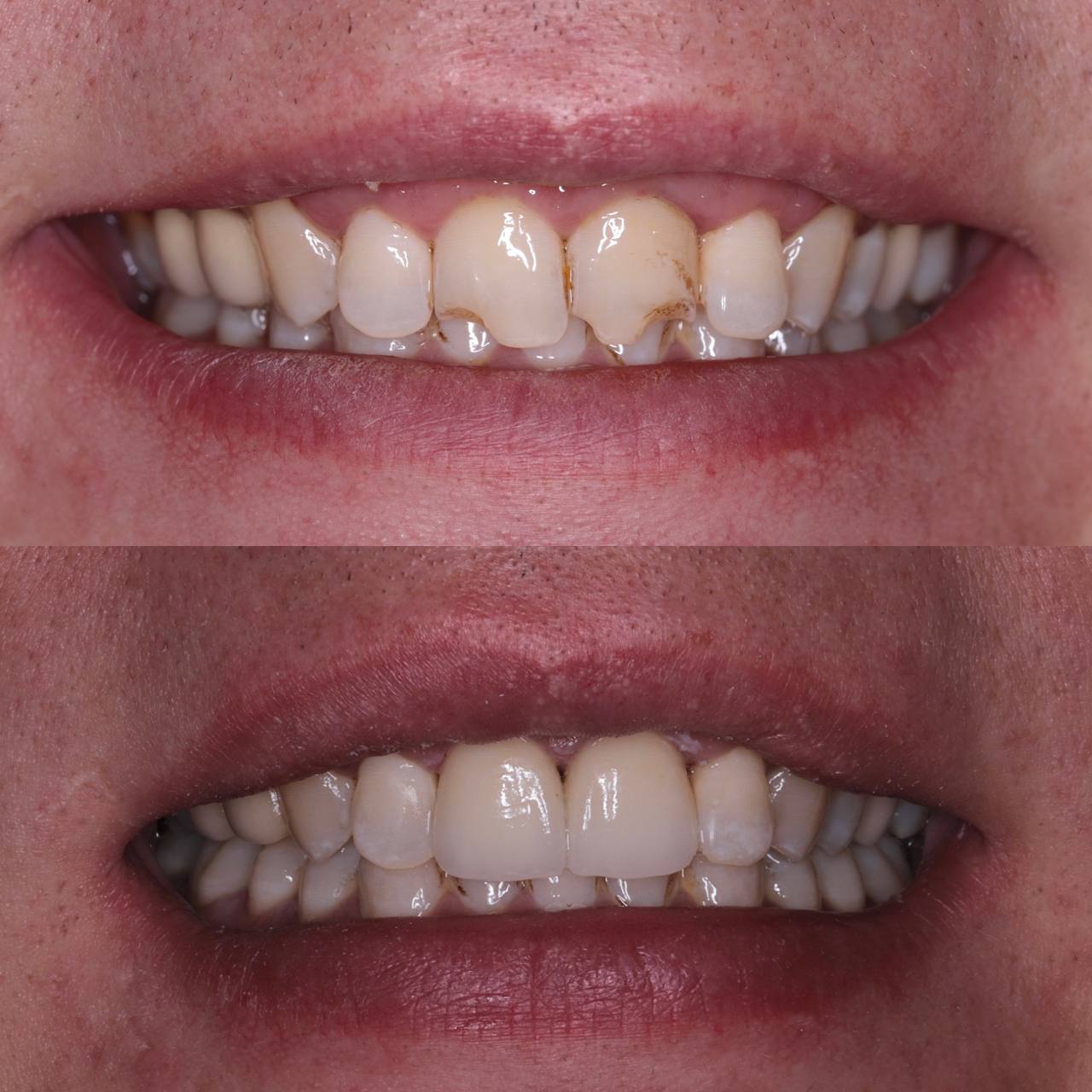 Emax Press ceramic veneers on individual teeth