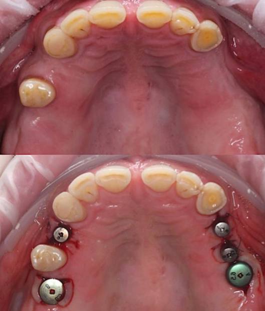 Neodent system implants