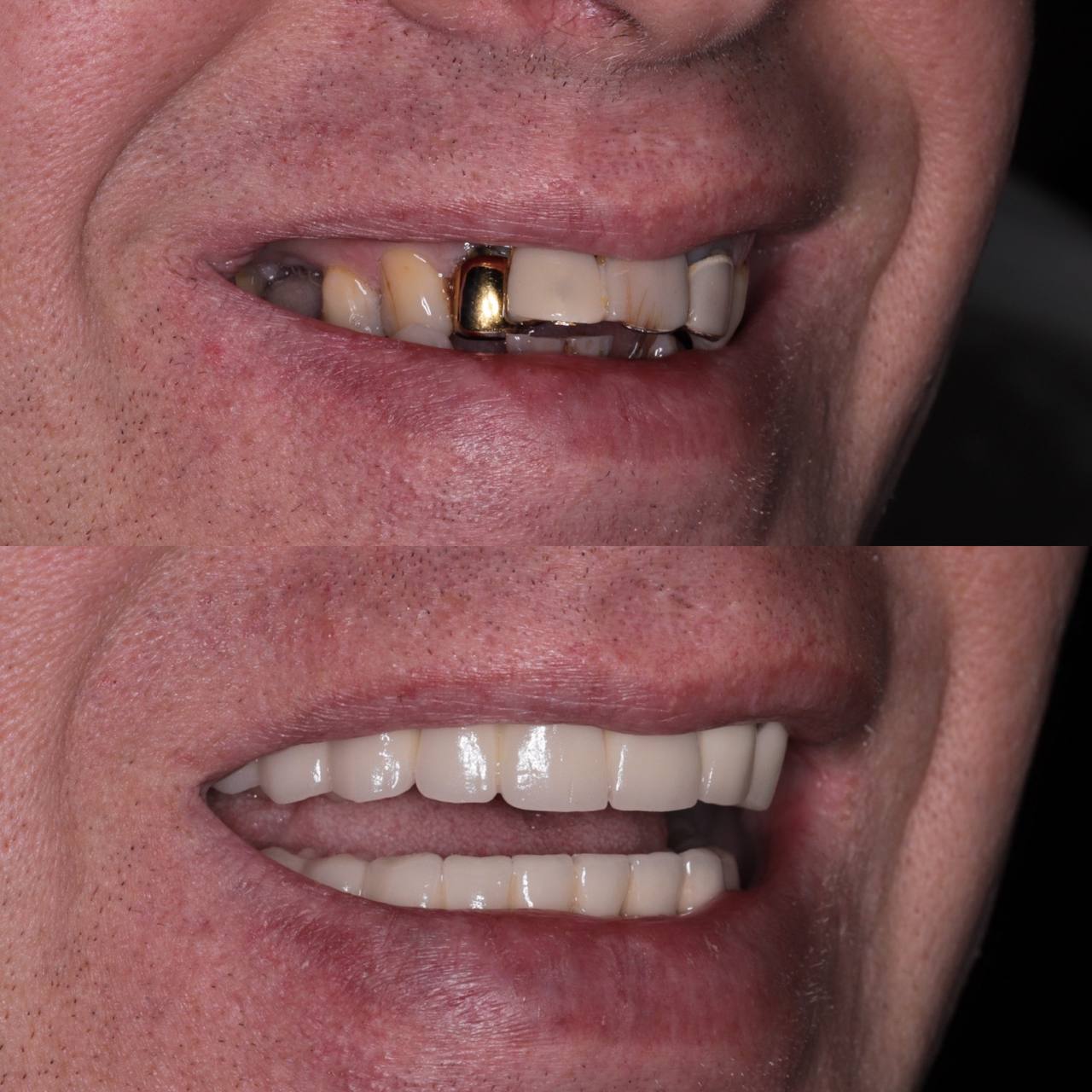 Metal-ceramic crowns