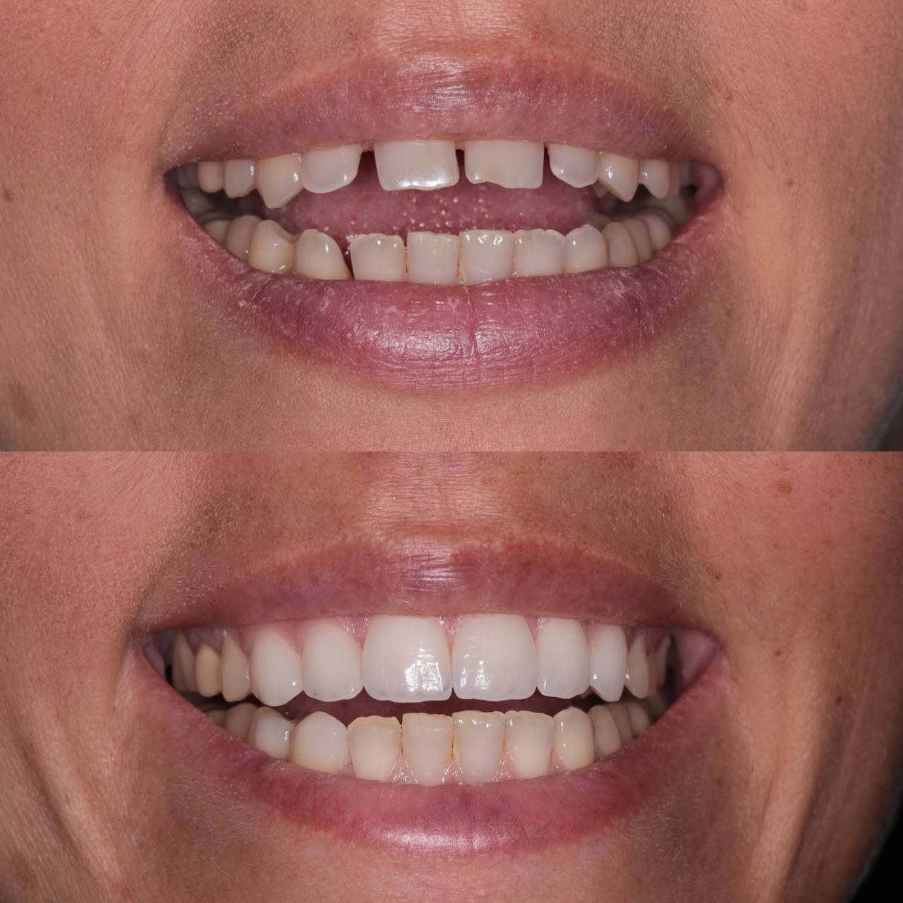 E-max.Press ceramic veneers
