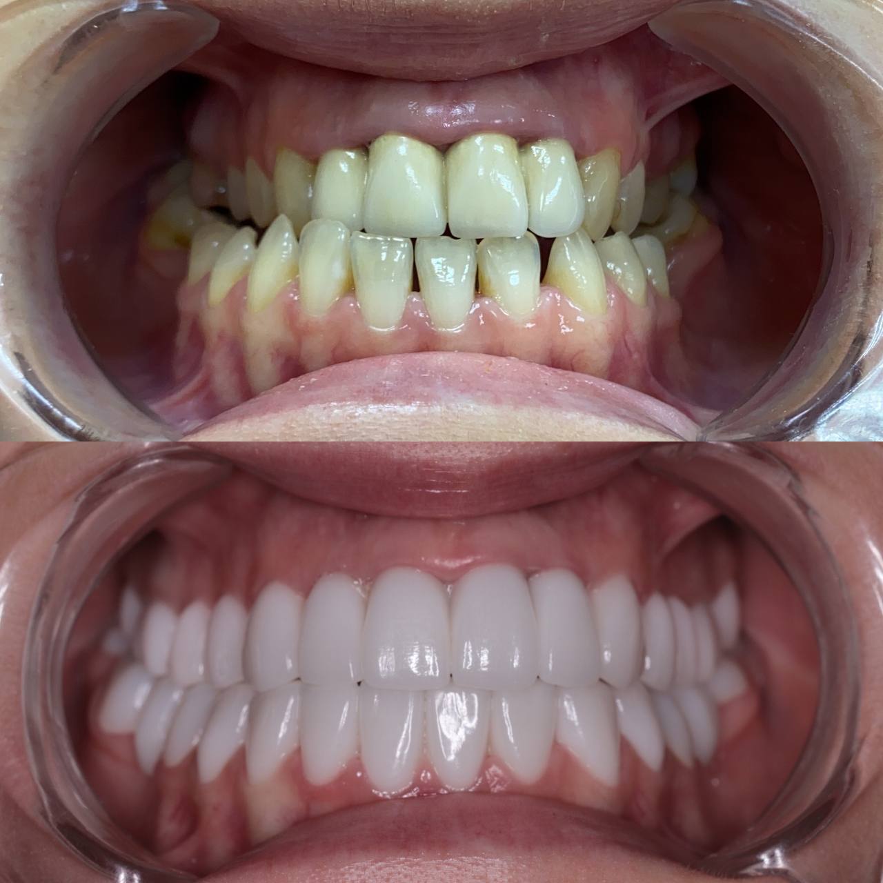 Zirconia-based crowns with ceramic layering