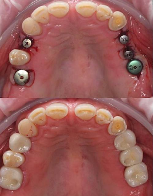 Zirconia crowns on implants